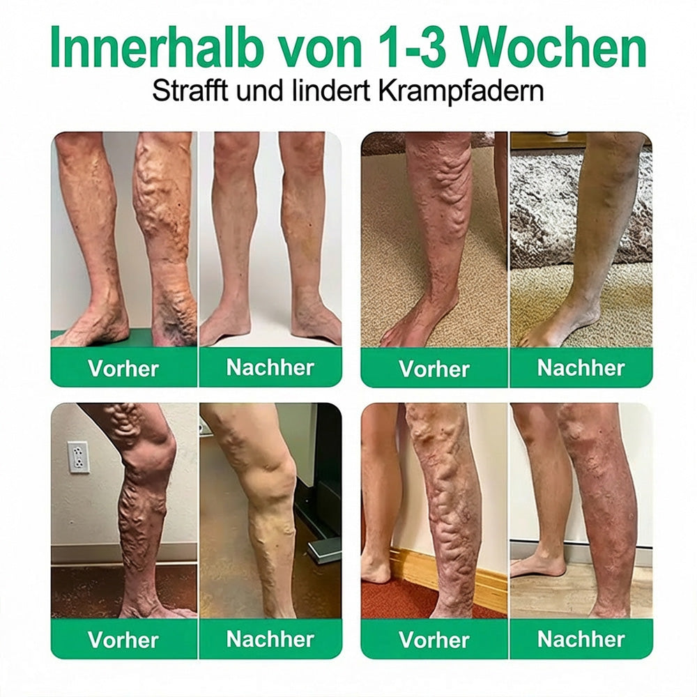 👨‍⚕️🔥Healrize® VeinEase Mikronadel-Technologie⚡Spürbare Wirkung in Tagen – nachhaltige Verbesserung