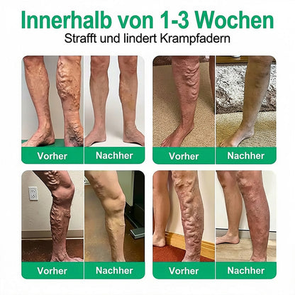 👨‍⚕️🔥Healrize® VeinEase Mikronadel-Technologie⚡Spürbare Wirkung in Tagen – nachhaltige Verbesserung
