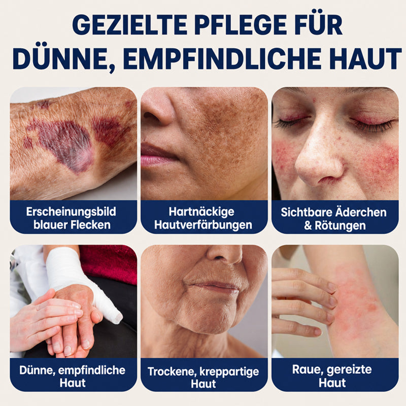 Kubozn® DermFortify – Spezial-Creme gegen blaue Flecken & zum Haut-Aufbau bei dünner, empfindlicher Haut