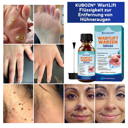 KUBOZN® WartLift Flüssigkeit zur Entfernung von Hühneraugen 🅱︎