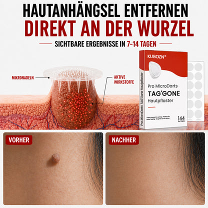 KUBOZN® Pro MicroDarts TAG'Gone Hautpflaster zur Skin-Tag-Entfernung  🅱︎