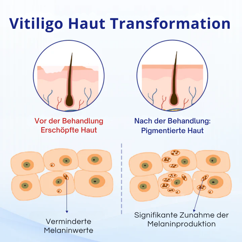 KUBOZN® Spray gegen Vitiligo — Dermatologisch getestet, pflanzlich & steroidfrei  🅱︎
