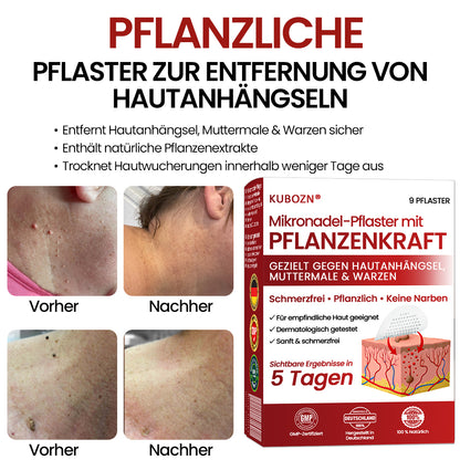 🔥 KUBOZN® Mikronadel-Pflaster – 2025 optimierte Formel gegen Hautanhängsel & Warzen