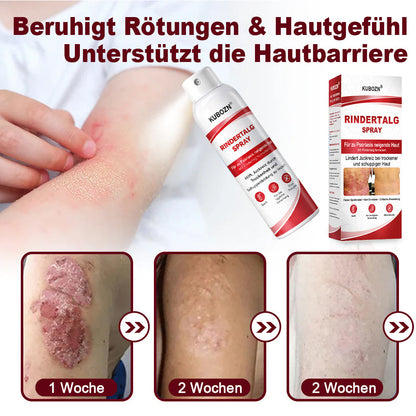 KUBOZN® Rindertalg-Spray für juckende, schuppige Psoriasis-Haut