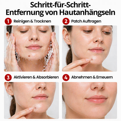 KUBOZN® Pro MicroDarts TAG'Gone Hautpflaster zur Skin-Tag-Entfernung  🅱︎