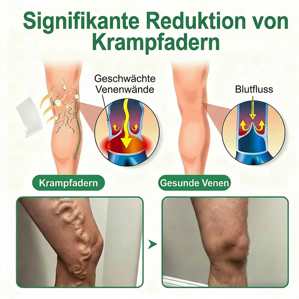👨‍⚕️🔥Healrize® VeinEase Mikronadel-Technologie⚡Spürbare Wirkung in Tagen – nachhaltige Verbesserung