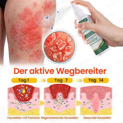 KUBOZN® Psoriasis Tag & Nacht System – 100% steroidfrei gegen Schuppen & Plaque