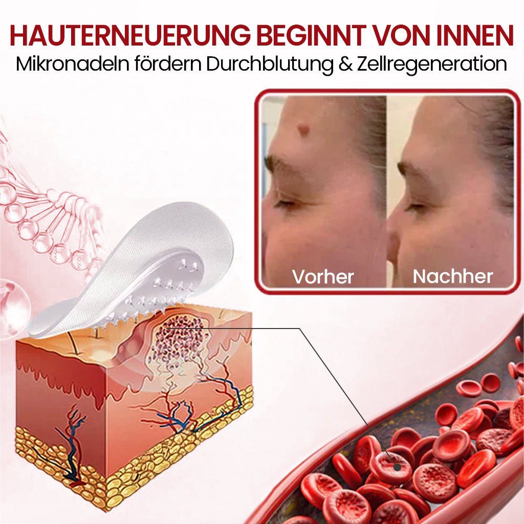 ⭐ KUBOZN® Mikronadel-Pflaster – 2025 optimierte Formel gegen Hautanhängsel & Warzen
