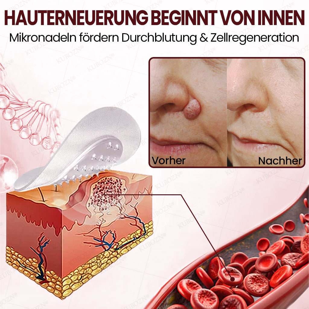 KUBOZN® OryzaDarts TAG’GONE – Schmerzfreie Entfernung an der Wurzel dank Schwarzer-Reis-Mikrotechnologie ✨ 🅱︎