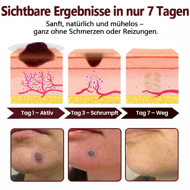 KUBOZN® OryzaDarts TAG’GONE – Schmerzfreie Entfernung an der Wurzel dank Schwarzer-Reis-Mikrotechnologie ✨