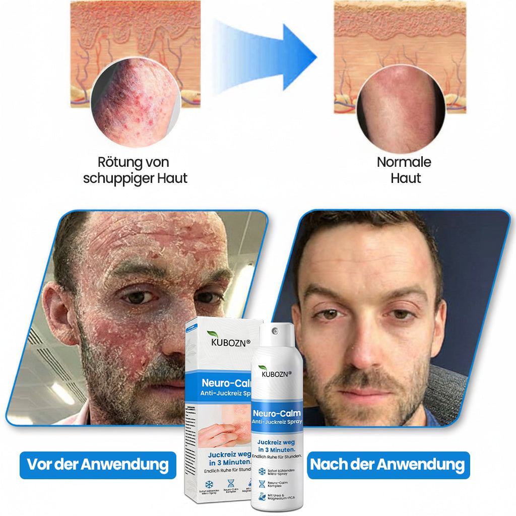 ✅KUBOZN® Neuro-Calm Anti-Juckreiz Akut-Spray – 3-Minuten-Ruhe bei Juckreiz