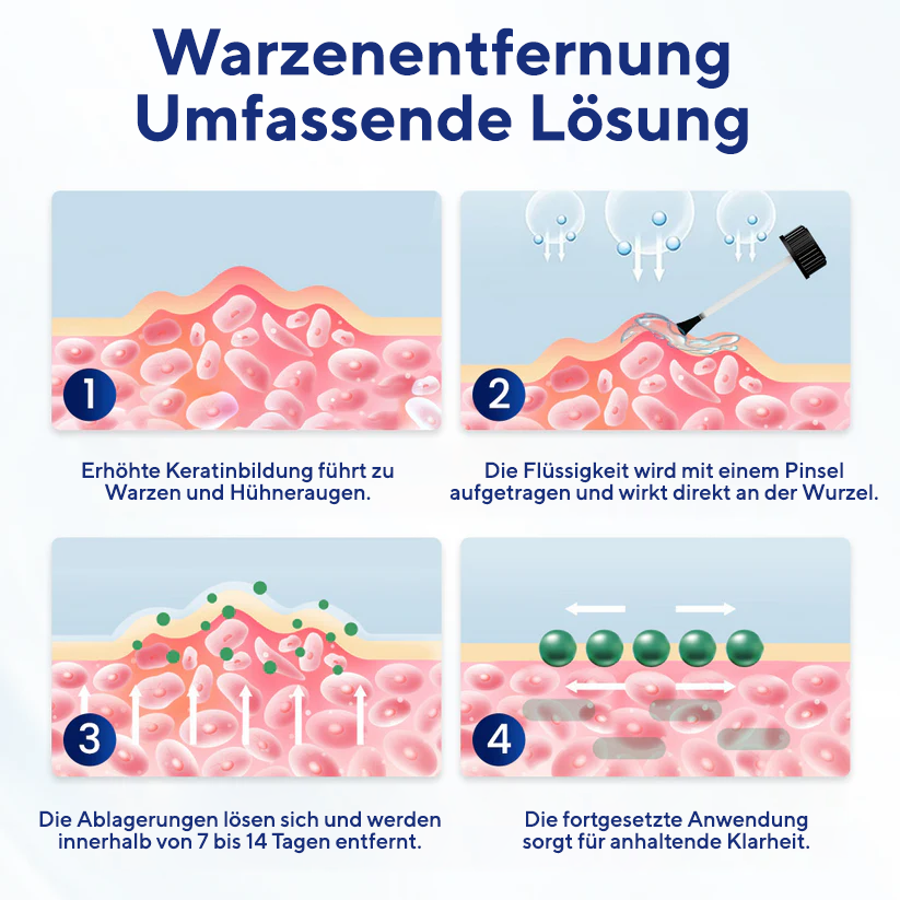 KUBOZN® WartLift Flüssigkeit zur Entfernung von Hühneraugen 🅱︎
