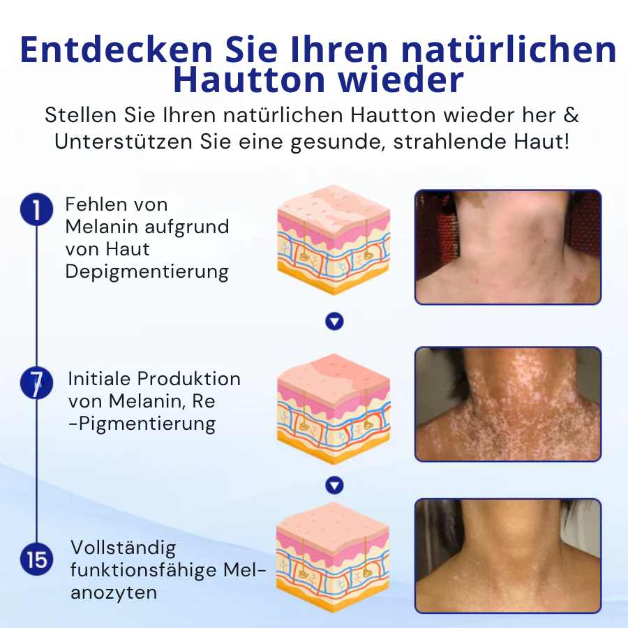 KUBOZN® Spray gegen Vitiligo — Dermatologisch getestet, pflanzlich & steroidfrei  🅱︎